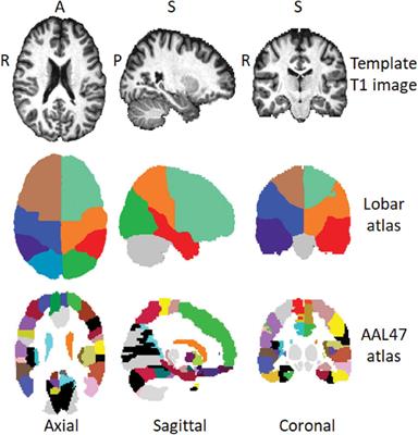 Whole-brain MR spectroscopic imaging reveals regional metabolite abnormalities in perinatally HIV infected young adults